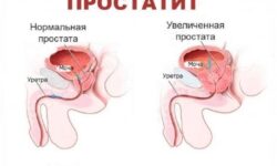 Когда следует обратиться к андорологу: симптомы простатита