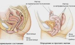 Выпадение матки