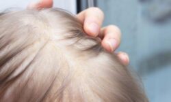 Опубликованы рекомендации по применению перорального миноксидила off-label