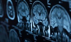 Воздействие загрязненного воздуха повышало риск развития менингиомы
